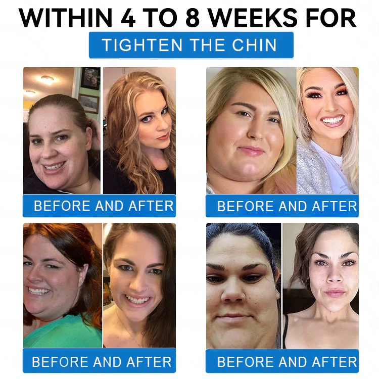 Clinically proven | WarmFamily®✅ SMGT-GLP-1 Nano Microneedle Patch with Collagen & Matrixyl 3000 | Obesity,Cardiovascular Diseas, Diabetes, Sleep Apnea, Joint Problems and More"
