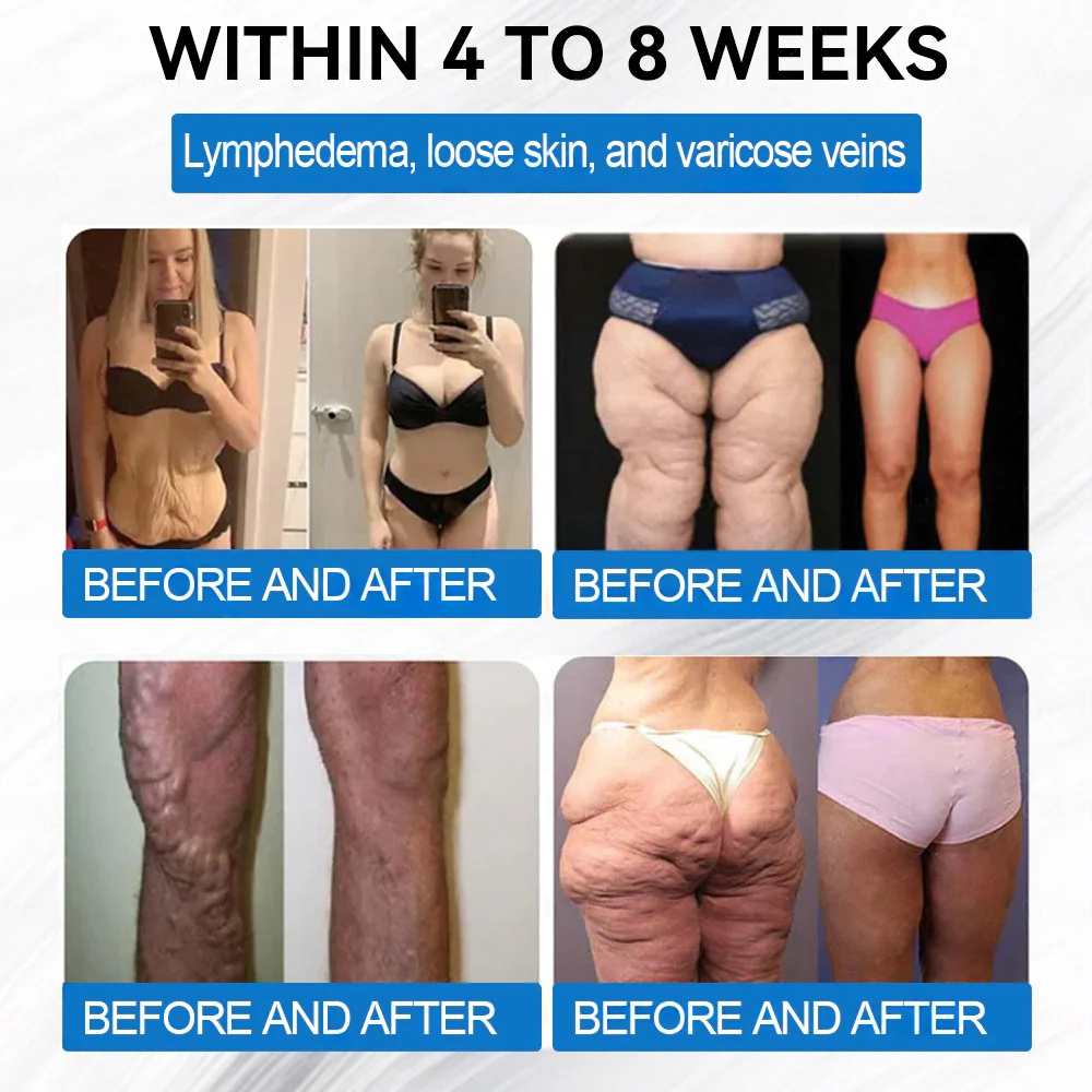 Clinically proven | WarmFamily®✅ SMGT-GLP-1 Nano Microneedle Patch with Collagen & Matrixyl 3000 | Obesity,Cardiovascular Diseas, Diabetes, Sleep Apnea, Joint Problems and More"